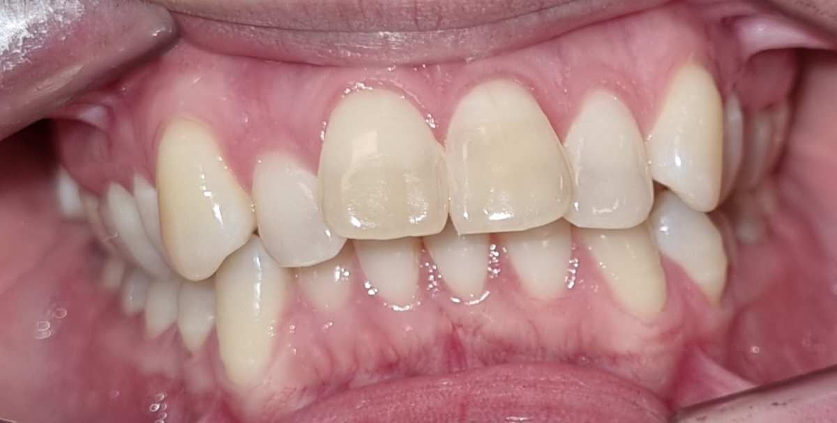 Apinhamento severo corrigido em 14 meses