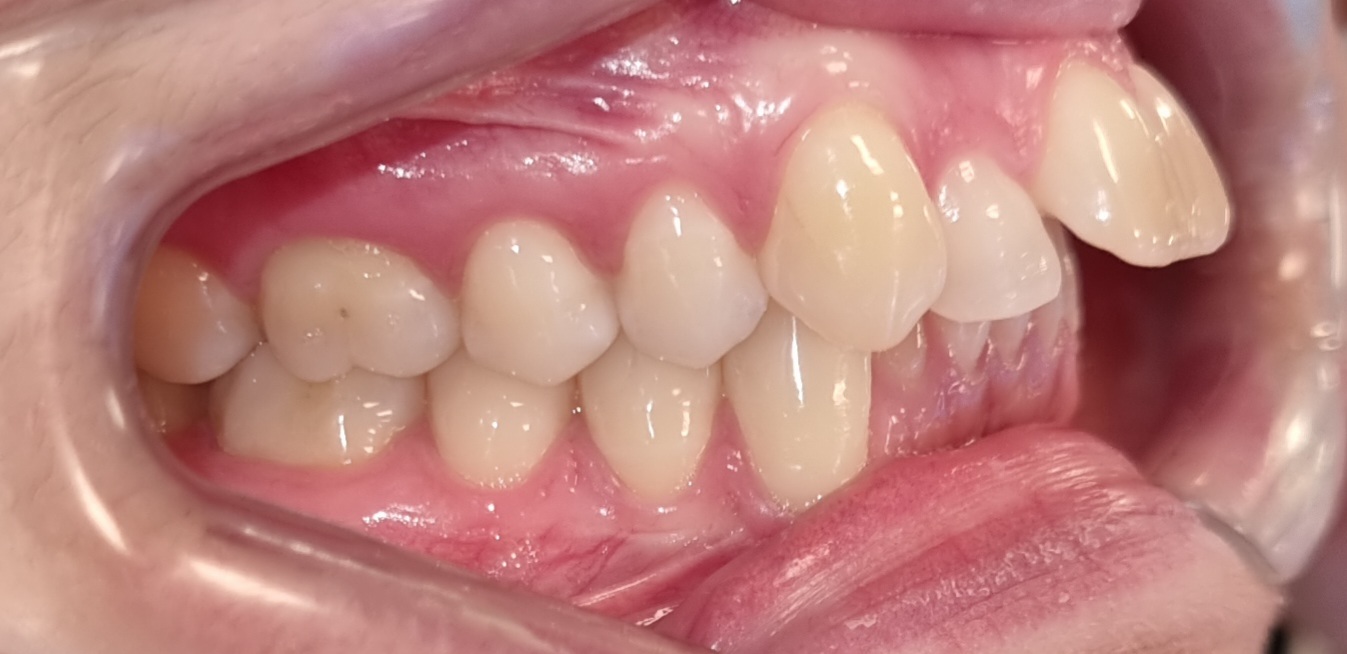 Caso cirúrgico tratado sem cirurgia