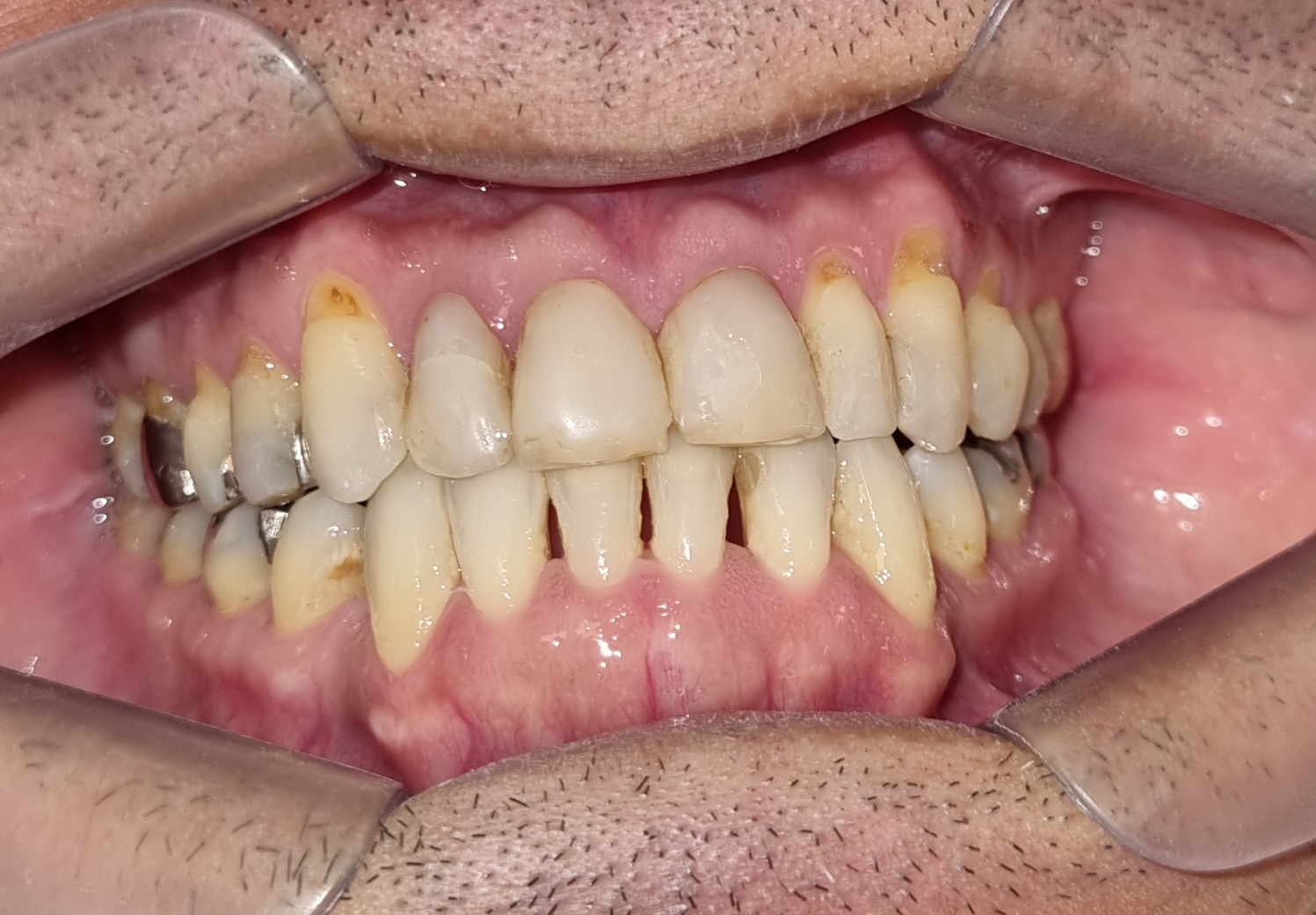 Caso complexo onde outros métodos falharam