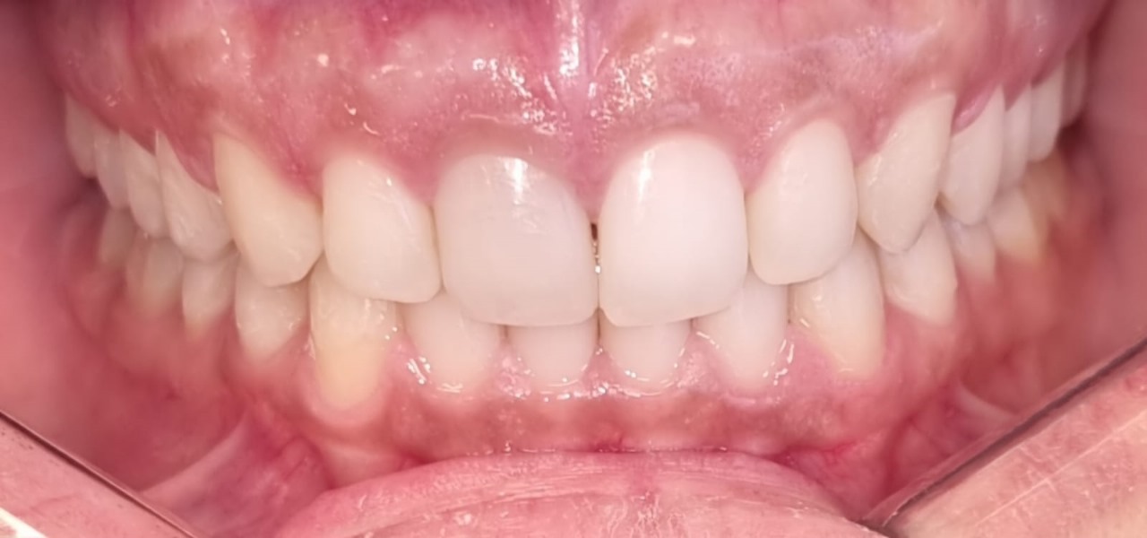 Mordida profunda corrigida em 12 meses